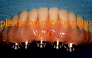Имплантация зубов и фиксация на шаровидных аббатментах